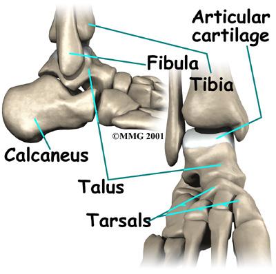 Depending on how the ankle is injured, the problem can occur on the side of the talus closest to the other foot or on the outside part.