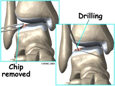 The chip fracture can vary in size and severity. If the bone underneath the cartilage is crushed or cracked and the articular cartilage is intact, the fragment is less likely to move.