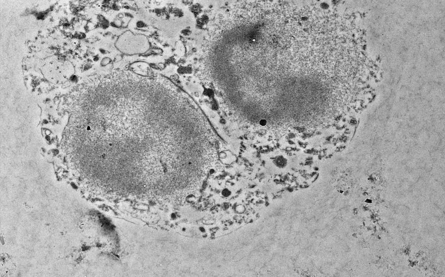 Cells are starting to show necrotic stage, evident with vacuolised
