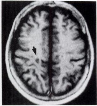 lesions when compared to normal brain tissue. On T2 weighted images (A), multiple sclerosis plaques appear as areas of high signal intensity (arrow), contrasting with surrounding normal white matter.
