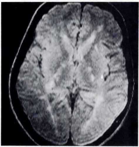 Supraventricular lesions were encountered in 84% of the patients in a study of anatomical distribution of disease by MRI