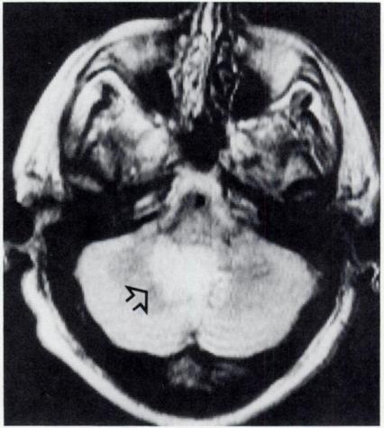 superficial view resemble multiple sclerosis.