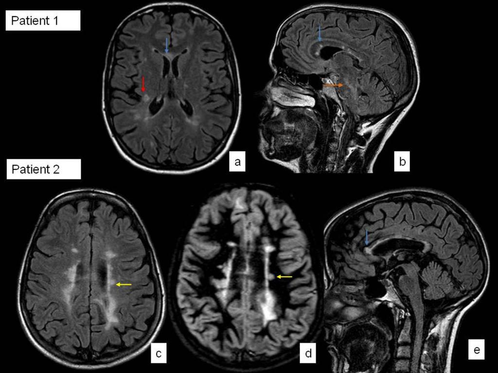 Fig. 18: Fig. MRI images of two different patients (a and b) and (c, d and e) with MS compatible lesions.