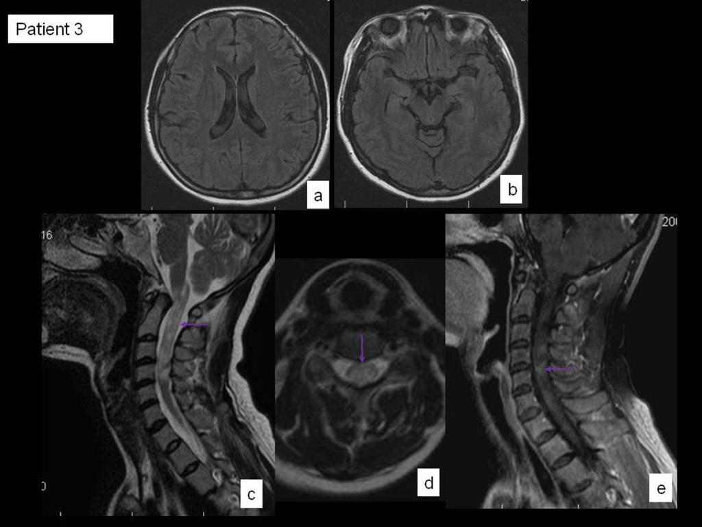 Fig. 20: Fig. Axial (a) and sagittal (b) fluid-attenuated inversion recovery images of brain without evidence of lesions.