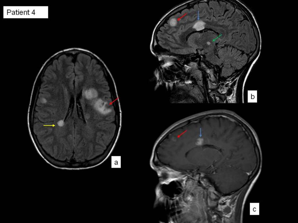 Fig. 22: Fig. Axial FLAIR (a), sagittal FLAIR (b) and axial T1-weighted postcontrast (c) images that show an ADEM.