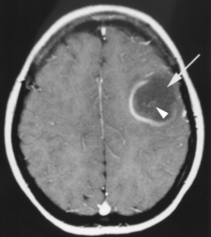 When the disease manifests as a single large or tumefactive demyelinating lesion within a cerebral hemisphere, the correct diagnosis is often not made until after surgical Pictorial Essay urtis.