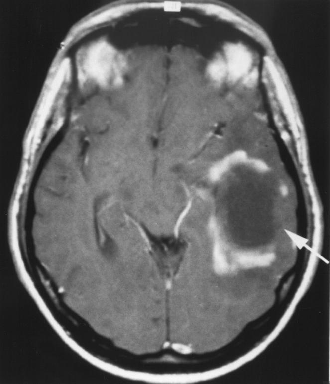 Symptoms are generally atypical for multiple sclerosis and usually relate to the presence of a focal mass lesion: focal neurologic deficit, seizure, or aphasia [3].