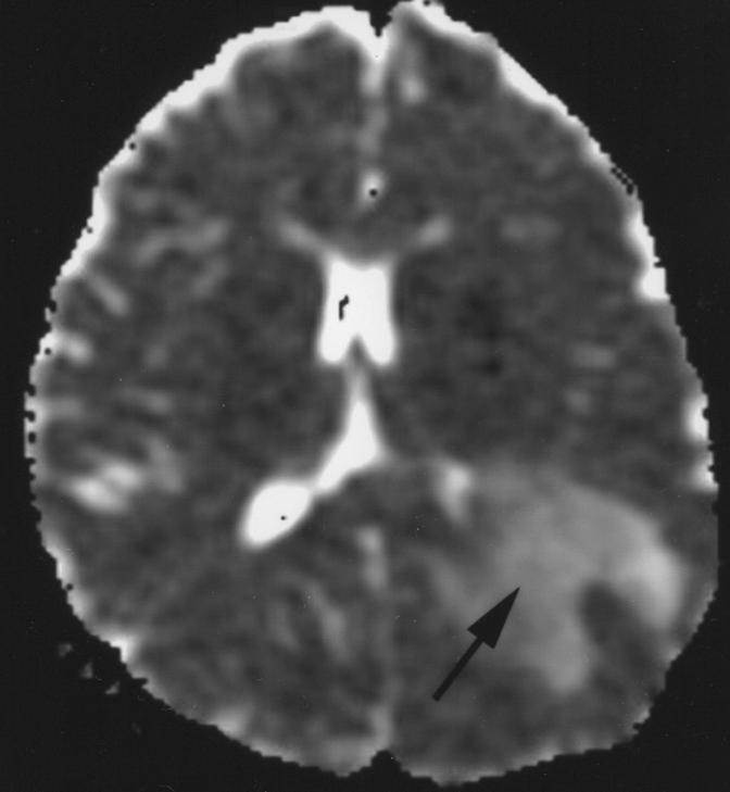 The enhancing portion of the ring is believed to represent the leading edge of demyelination and thus favors the white matter side of the lesion [5].