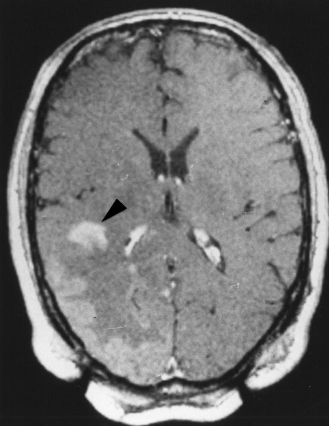 Several nonneoplastic brain lesions (including tumefactive demyelinating le- sions) may produce an identical MR spectrum, mimicking a neoplastic process [7, 8] (Fig. 3).