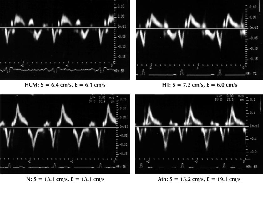 or mild obstructive HCM) was provided by a mean systolic annular velocity <9 cm/s or a mean early diastolic annular velocity <9 cm/s (Figure 3) (32).