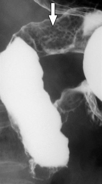 layer of submucosal fat in the duodenum and jejunum. Her medical history included seasonal allergies, gastroesophageal reflux disease, and hyperlipidemia.