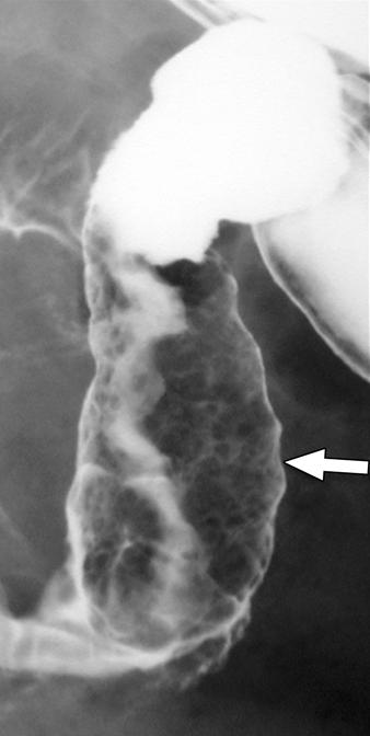 An upper gastrointestinal barium study was performed in June 1999, at which time celiac disease with a bubbly nodularity in the bulb and in the fold-free duodenal sweep (Fig.