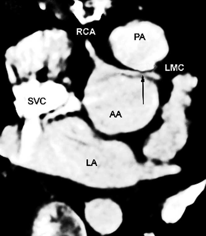 Ou et al Figure 2. Compression of the left main coronary artery (arrow) between the neoascending aorta and the pulmonary trunk.