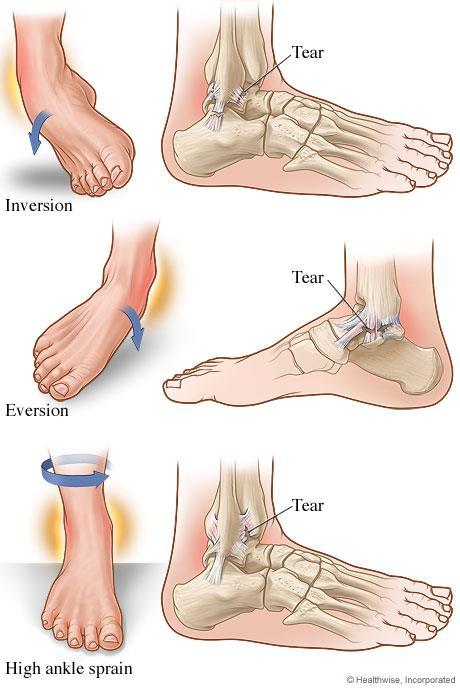 Inversion: when the ankle