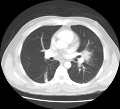Case #3 (cont d) Algorithm for possible fungal pneumonia Diffuse Infiltrate Chest Imaging Patchy or Nodular Fungus unlikely Consider biopsy Treat as fungal infection No Yes Normal No Antigen + PCR +