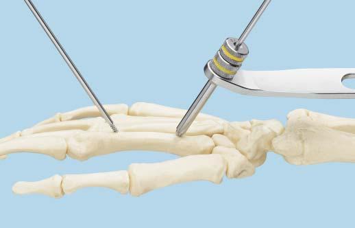 Technique Overview continued 1 Insert metacarpal pins To avoid entrapping the extensor mechanism in extension, flex the second