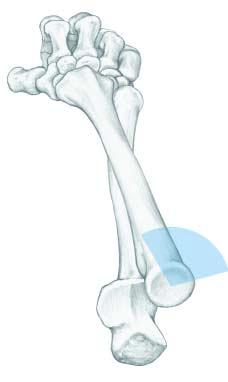 The Hotchkiss safe zone is located on the opposite side of the radial tuberosity.