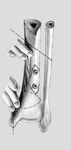Preparation 1 Plate contouring For the treatment of juxta-articular fractures (distal tibia, tibial plateau, distal femur, distal humerus, radius etc.