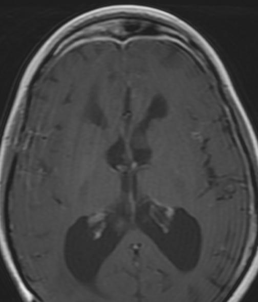 hyperintensity and thickening (arrows) of the bilateral parasagittal frontal