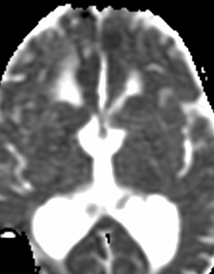 water diffusion in the bilateral parasagittal frontal cortices