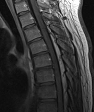 Value of CISS Sagittal and axial postcontrast T1 weighted images of the spine of a 15 year old