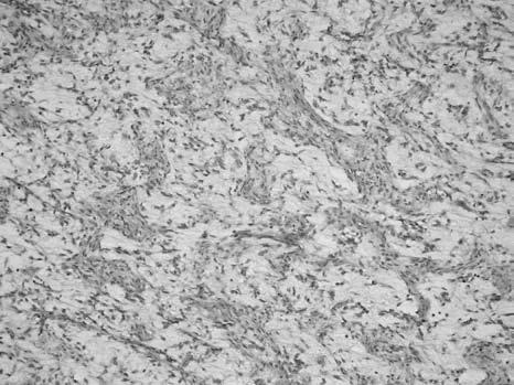 SVETLOĆELIJSKI SARKOM BUBREGA SLIKA 5. Mezoblastni nefrom. FIGURE 5. Mesoblastic nephroma. naći zarobqeno duboko u tumoru (Slika 5).