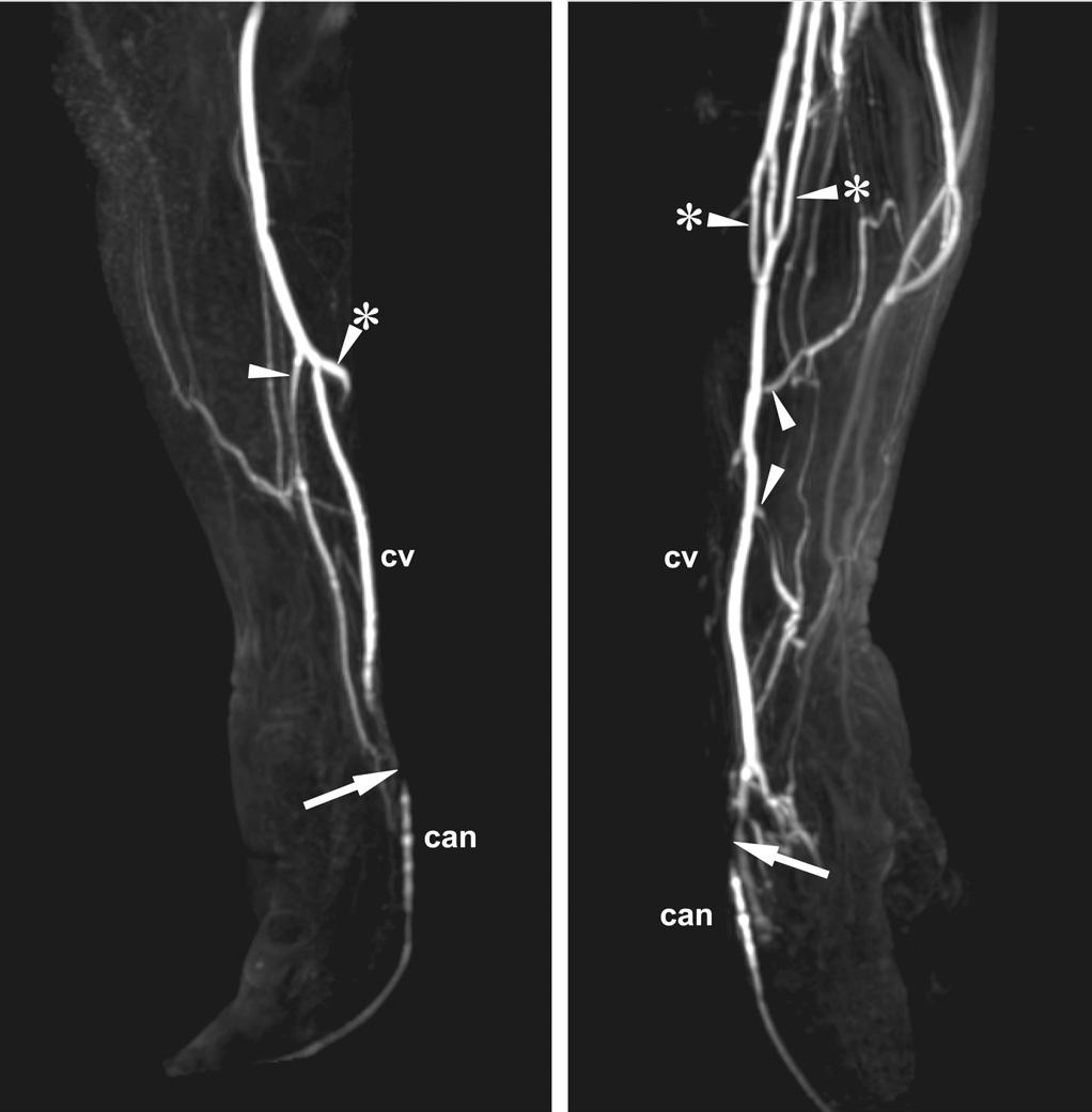 Accessory veins are associated with RC-AVF non-maturation Fig.