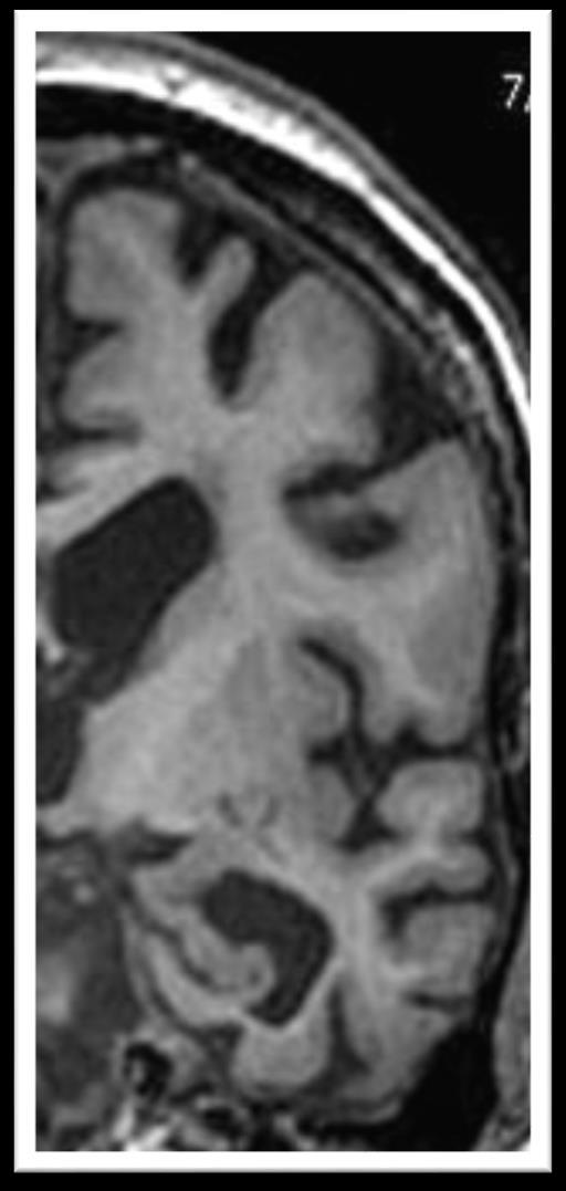 Both Moderate Decrease In Thickness And Widening Of Collateral Sulcus