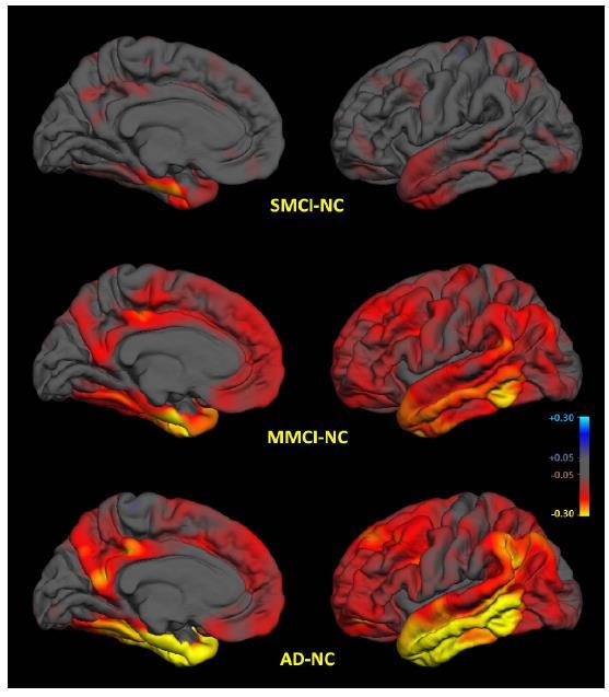 MRI Biomarker and AD Progression (Reduction in Cortical Thickness Associated with Disease Stage