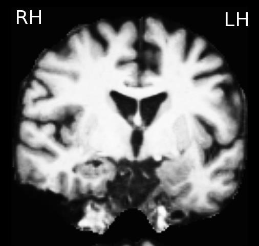 Case #3 Structural MRI