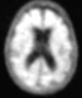Amyloid PET scan: