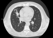 Case 2: 72 yo M 60 pack year former smoker Enlarging right middle lobe nodule on CT PET-CT