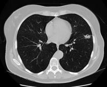 Case 3: 75 yo F 45 pack year smoker Multiple lung nodules on screening chest CT RUL nodule 1: 14x12 mm RUL nodule 2: 12x11 mm LLL ground glass opacity: 17 mm LLL cavitary nodule: 15mm Enlarged R