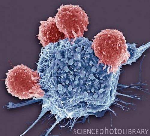 T lymphocytes and cancer cell. Coloured scanning electron micrograph (SEM) of T lymphocyte cells (red) attached to a cancer cell.