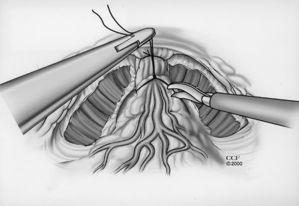 LAPAROSCOPIC RADICAL PROSTATECTOMY Figure 2 Anterior traction on the back bleeding stitch helps to identify the appropriate plane of dissection between the prostate base and the bladder.