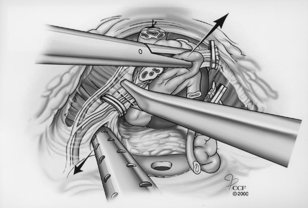 LAPAROSCOPIC RADICAL PROSTATECTOMY NEUROVASCULAR BUNDLE DISSECTION IMPACT OVER POSTOPERATIVE POTENCY Initially, the lateral pedicles of the prostate are controlled with one or two 10 mm Hemolock