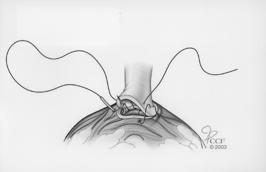 LAPAROSCOPIC RADICAL PROSTATECTOMY Laparoscopy, with its enhanced and magnified vision in a relatively bloodless field allows for excellent identification and handling of the neurovascular bundles
