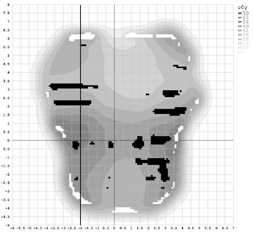 92 Bailey et al.: EPID pretreatment QA 92 Fig. 5. The same prostate field examined for Fig. 3 (middle), showing the vertical dose profile examined in Fig.