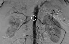 Rev Chil Radiol 2016; 22(1): 13-19. Angioplasty with stent in renal artery stenosis: our experience Johanna Marcela Vasquez Veloza *, José Luis Abades Vázquez, José Luis Cordero Castro.