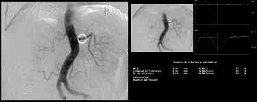 Abstract In this study we provide the results and effectiveness of angioplasty with stent in patients with renal artery stenosis who presented as well with a poorly controlled or refractory