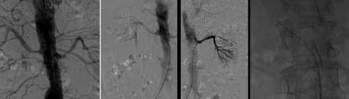 J.M. Vasquez Veloza et al. Rev Chil Radiol 2016; 22(1): 13-19. Figure 4. Bilateral renal arteriography is performed via the right femoral artery.