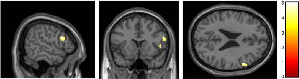 J.M. Hooley et al. / Psychiatry Research: Neuroimaging 172 (2009) 83 91 87 Fig. 2.