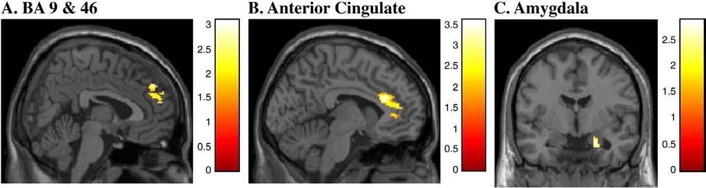88 J.M. Hooley et al. / Psychiatry Research: Neuroimaging 172 (2009) 83 91 Fig. 3. Criticism.