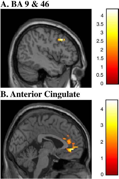 90 J.M. Hooley et al. / Psychiatry Research: Neuroimaging 172 (2009) 83 91 Fig. 5. Neutral.