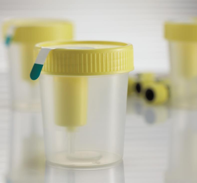 Pre-Analytical Considerations Primary urine collection container requirements: Allow for ease of collection, ease of sampling, appropriate for uropathogen detection For patient convenience, have a