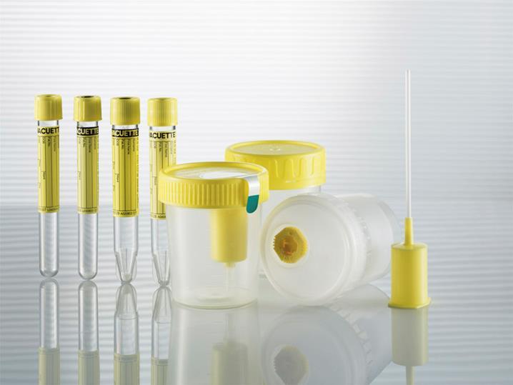 Pre-Analytical Considerations Secondary urine containers Aliquot of primary specimen into a vacuum tube Potential decrease in casts due to disintegration during vacuum aspiration Potential release of