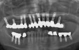 a b c Fig 1 Panoramic radiographs of a patient who underwent mandibular complete arch