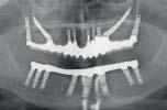 a b c d Fig 3 Panoramic radiographs of a patient who underwent mandibular left posterior