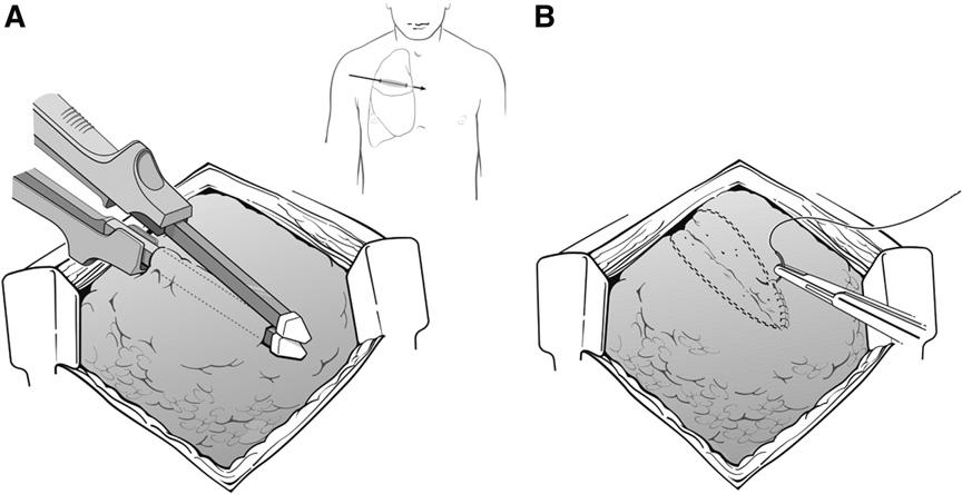 THORACIC TRAUMA: WHEN AND HOW TO INTERVENE 107 Fig. 3. Tractotomy for nonhilar injuries.
