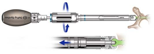 FIGURE 15 NOTE: If it is desired to implant a EXPEDIUM VERSE Screw following removal of the extended tabs, the Poly Driver Shaft (removed from the Poly Driver Handle) or the X25 Inserter/Tightener